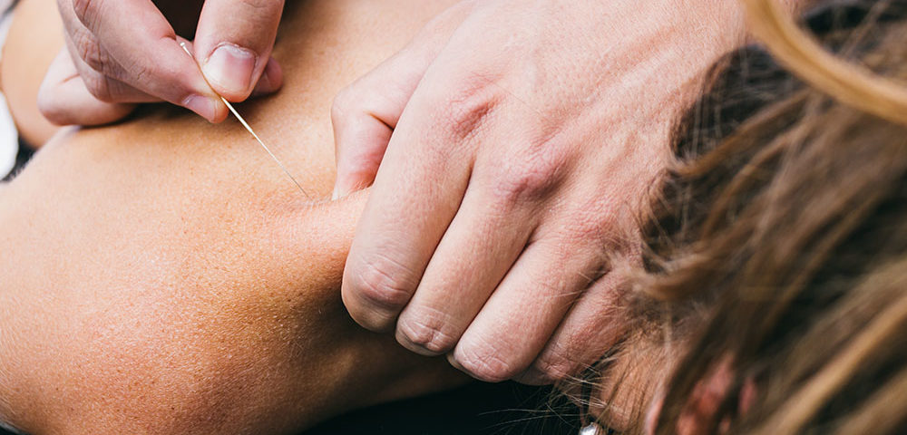 Dry Needling in Islamabad